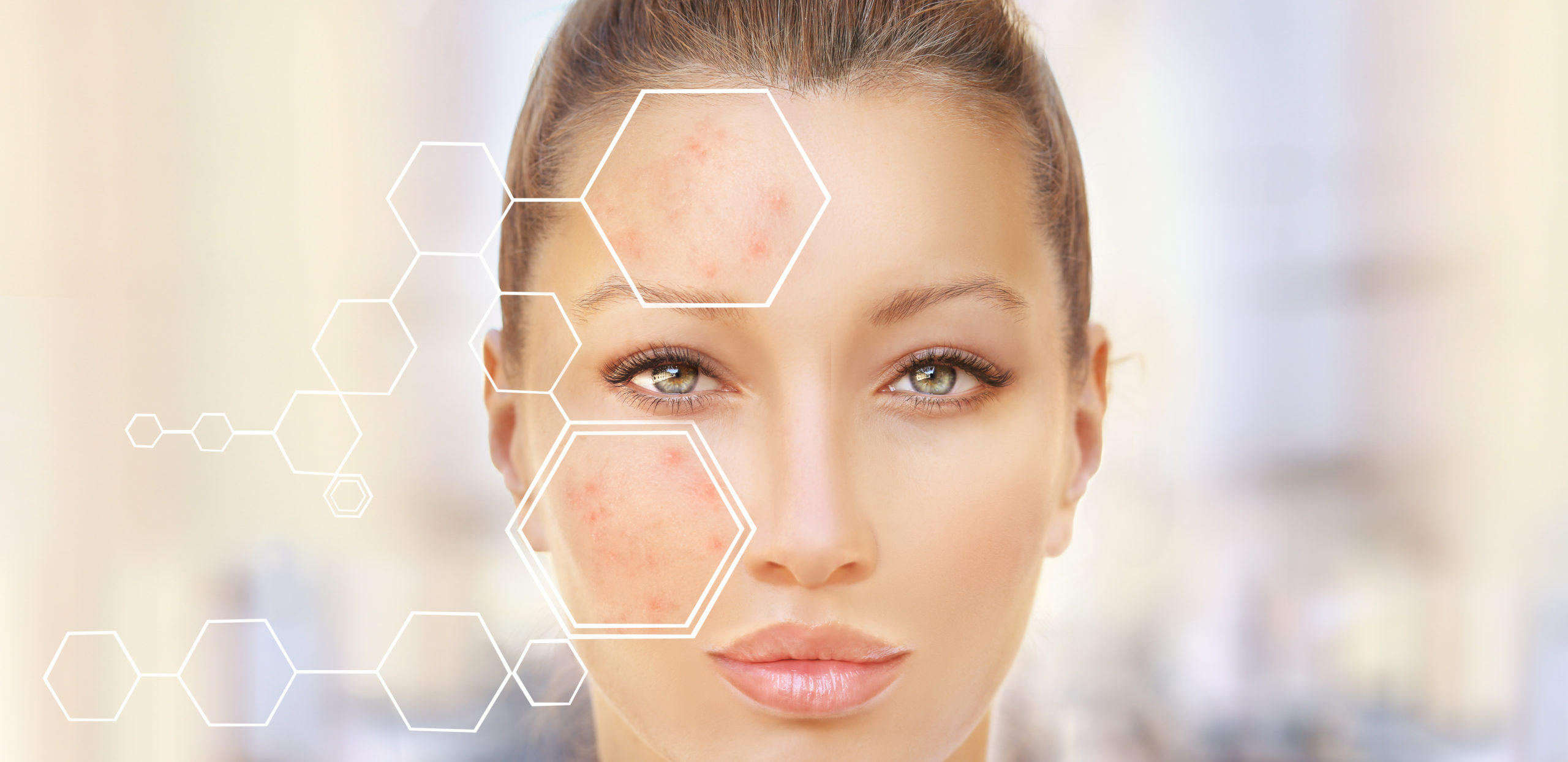 L’isotrétinoïne pour traiter l’acné : quelles précautions ?